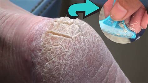 How To Remove Dead Skin From Feet With Razor Foot Hard Skin Remover