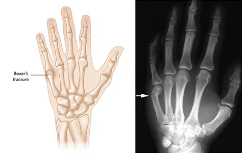 Finger Fractures Orthoinfo Aaos