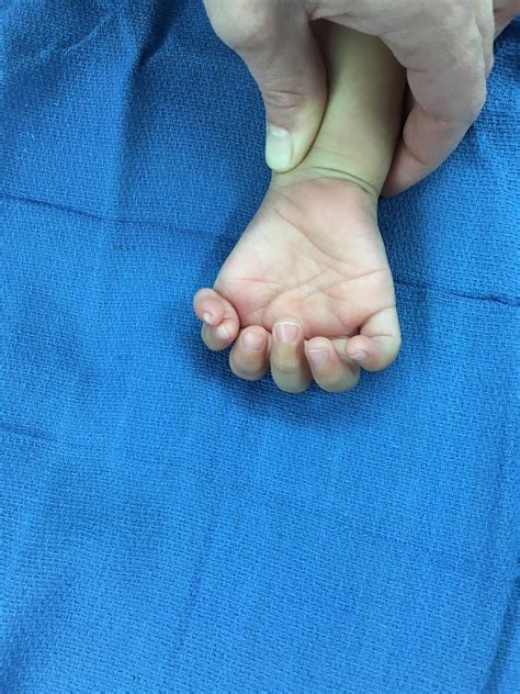 The 5 Finger Hand Congenital Hand And Arm Differences