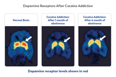 How Does Addiction Affect The Brain Ask Our Doctors By Journeypure