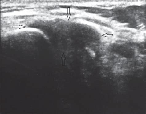 The Surface Ultrasound Sonography Test Of The Sternoclavicular Joint