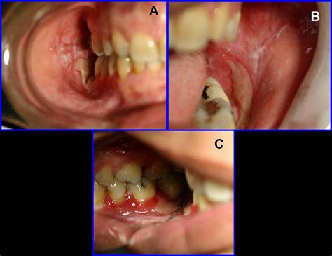 Chronic Ulcerative Stomatitis Diagnostic And Management Challenges