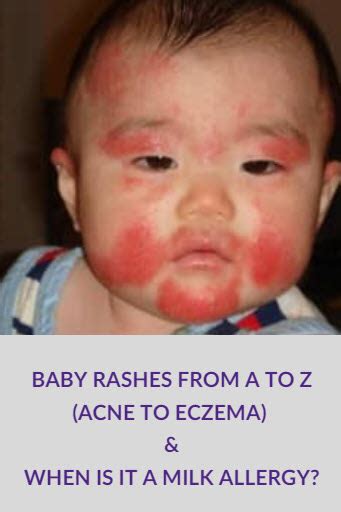 Allergic Reaction Rash Baby