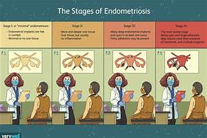 Stages Of Endometriosis