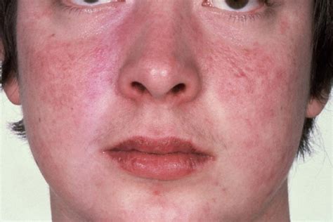 What Causes Redness And Itching On Face Allergy Differences