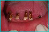 Can Dental Implants Be Done In A Day Photos
