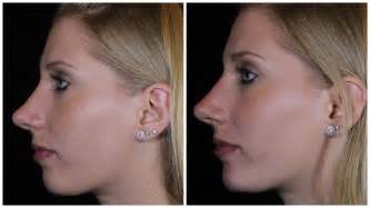 Reshaping Your Nose Without Surgery Sonata Aesthetics