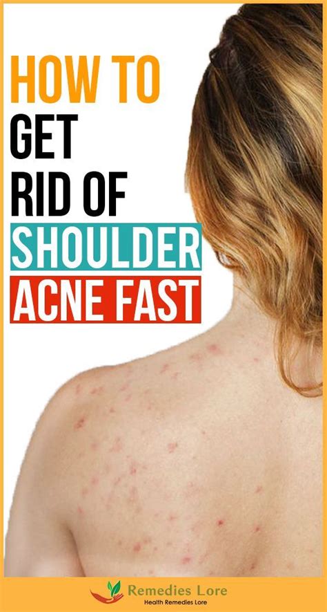 How To Get Rid Of Acne On Arms And Shoulders Howtoremvo