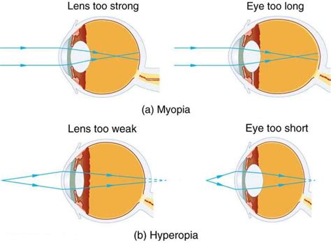 Correction Of Various Eye Vision Disorders By Lens Hyperopia Myopia And