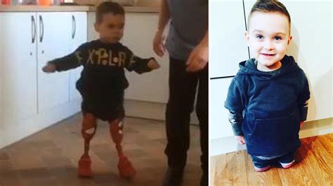 3 Year Old Amputee Takes First Steps By Himself On Prosthetic Legs