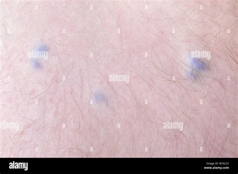 Varicose Vein Disease In A Man Closeup Image Stock Photo Alamy