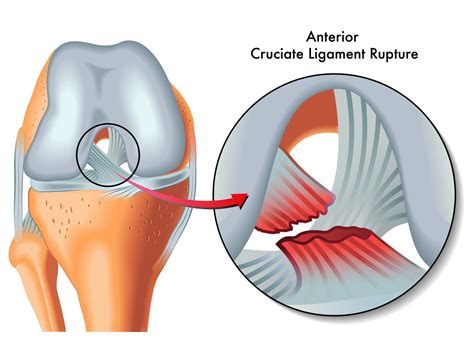 Diagnosis can be suspected clinically with presence of a traumatic knee effusion with increased laxity. Knee Ligament Injuries Singapore | Tears in ACL, MCL & PCL