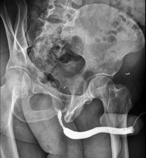 Bulbar Urethral Stricture Image