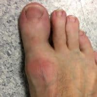 Living With Osteoarthritis Of The Foot And Ankle SES Podiatry