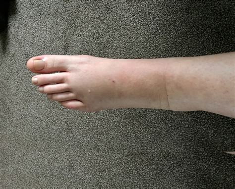 Swollen Ankles In Pregnancy Why Do They Occur