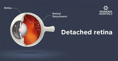 Peripheral Vision Loss Causes Diagnosis Prevention And Treatment