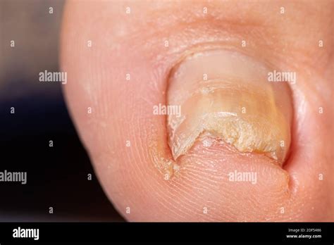 Fungus Of Nails On The Big Toe Dermatomycosis And Onychomycosis
