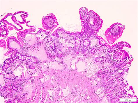 Pathology Outlines Lymphangiectasia