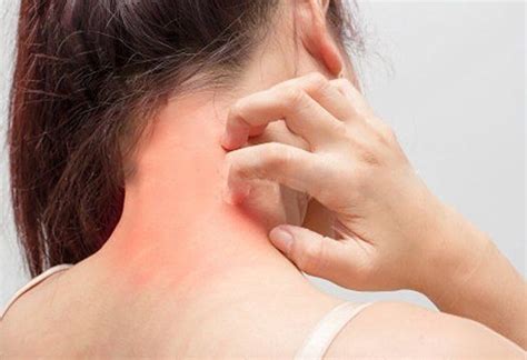 Top 10 Most Effective Home Remedies For Skin Rashes