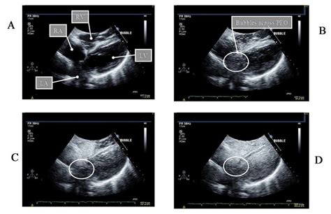 Bubble Study Diogram Was Performed The Echocardiogram Showed Breast