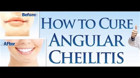 Angular Cheilitis Treatment Emedicine Overnight Cure 😁 Youtube