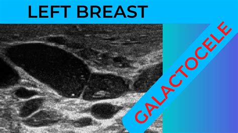 Left Breast Galactocele On Ultrasound Scan Youtube