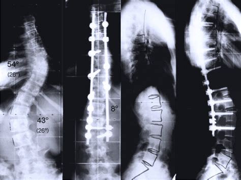 36 A 14 Year Old Girl With Idiopathic Double Curve Scoliosis There