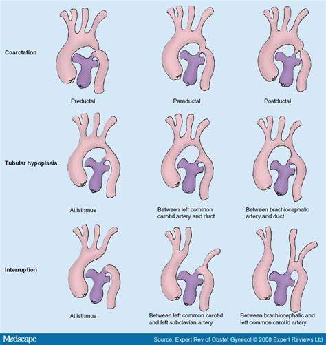 Coarctation Of The Aorta Fetal And Postnatal Diagnosis And Outcome