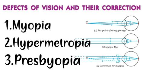 Myopia Hypermetropia Presbyopia Defects In Human Eye And Their Correction Class 10 Physics