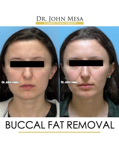 Patient 148733477 Buccal Fat Pad Removal Gallery