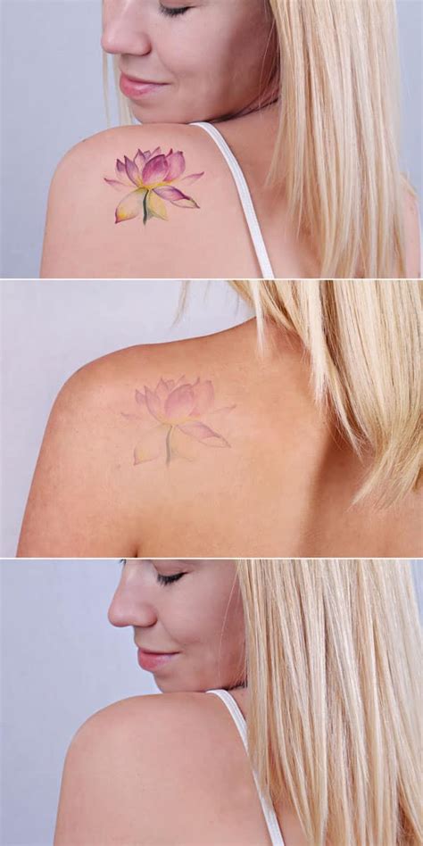 Laser Tattoo Removal Toronto 01 Toronto Facial Plastic Surgery And