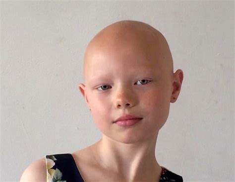 Eight Year Old With Alopecia Defies Bullies To Embrace Being Bald
