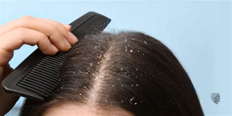 Scalp Fungus Here Is What You Can Do About It Ahs Uae