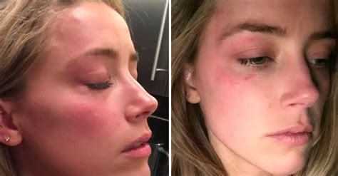 Amber Heards Photos With Bruised Face After Johnny Depp Allegedly Threw Phone At Her Shown In