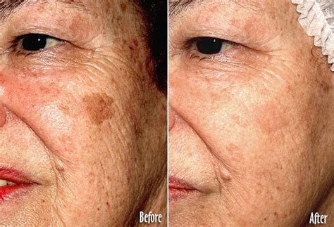 Treating Age Spots In Highland And New Paltz Essence Medispa Cosmetic