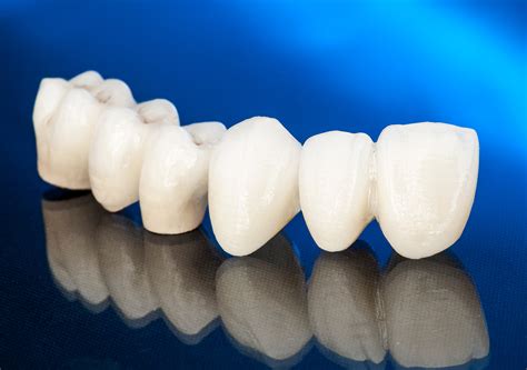 Dental Crowns Garland Tx Tooth Bridges Oral Health Kings Dental