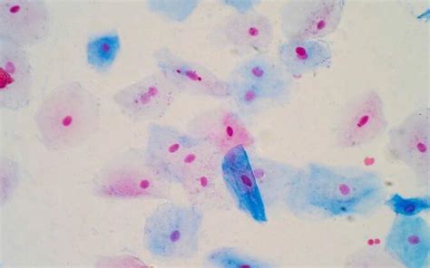 Células epiteliales escamosas qué son características enfermedades