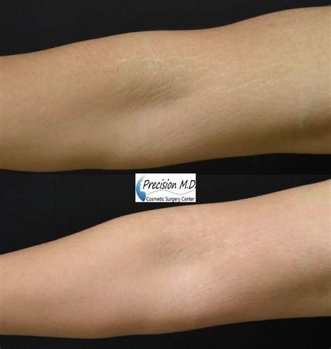 stretch marks treatment before and after arms