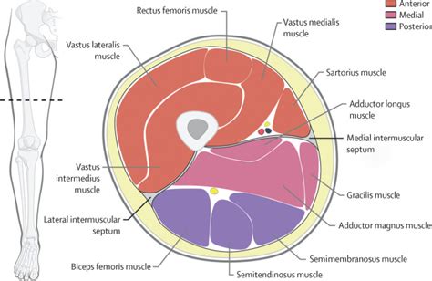 Your hamstring tendons run behind your knee and meet your patellar tendon. Diagnosis and treatment of acute extremity compartment syndrome - The Lancet