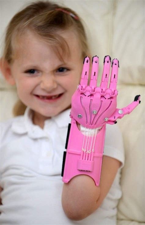 Hayley Fraser Only Five Years Old And Her 3d Printed Prosthetic Hand
