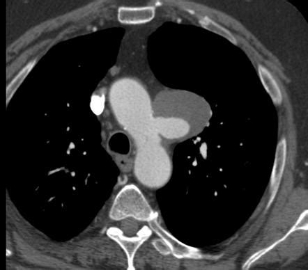Thoracic Aortic Aneurysm Radiology Reference Article Radiopaedia Org