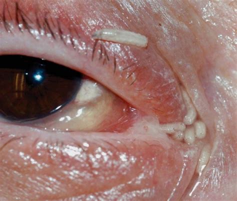 120 Maggots Removed From Womans Nose And Eye After Fly Lays Eggs In