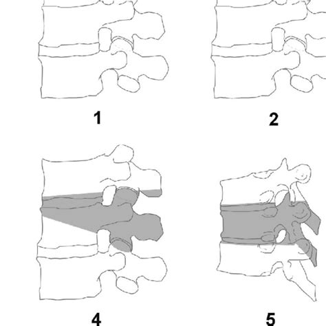 Osteotomy Classification Grades 16 According To The Anatomical