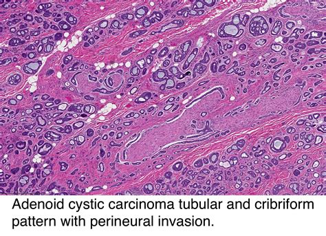 It has a distinct histopathological appearance. Pathology Outlines - Adenoid cystic carcinoma