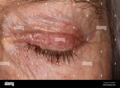 Model Released Eczema Affecting The Skin Around A 71 Year Old Womans