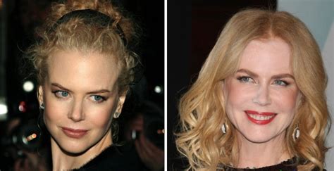 Nicole Kidman Et La Chirurgie Esthétique - Les photos avant et après de 12 célébrités défigurées par la chirurgie