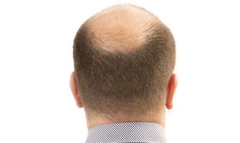 Understanding Mens Hair Loss On The Norwood Scale