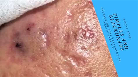 Milia Cystic Acne Pimples And Blackheads Extraction Acne Treatment