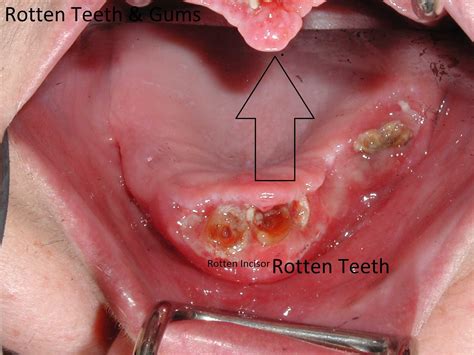 Rotten Teeth and Gums - Dr. Caputo | Palm Harbor Dentist