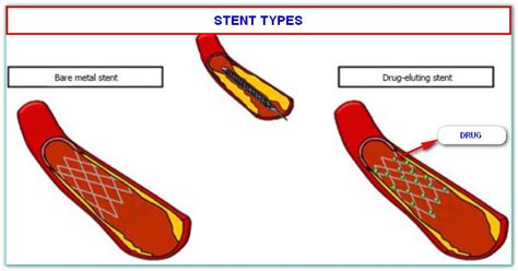 Facts About Stent Surgery To The Heart Angioplasty Or Ptca Or Pci